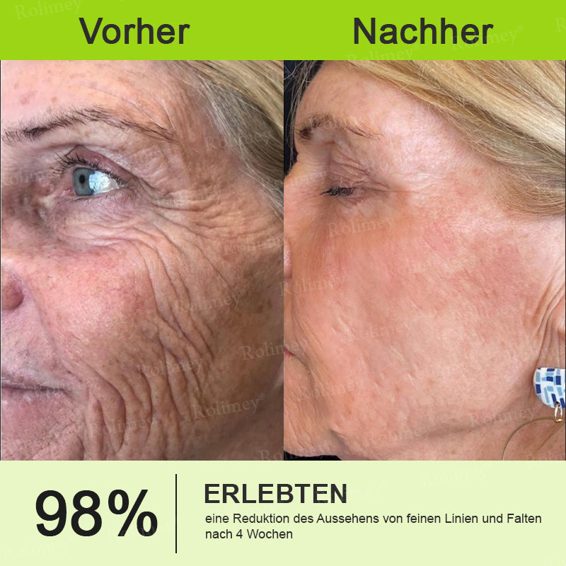 💫💫🍀Jetzt jugendliche Haut zurückgewinnen 💫Rolimey® Botox & Vita-A Retinol Shot Falten-Lift Straffungscreme👩‍🔬LETZTER TAG – 70 % RABATT