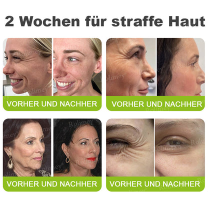 💫💫🍀Jetzt jugendliche Haut zurückgewinnen 💫Rolimey® Botox & Vita-A Retinol Shot Falten-Lift Straffungscreme👩‍🔬LETZTER TAG – 70 % RABATT