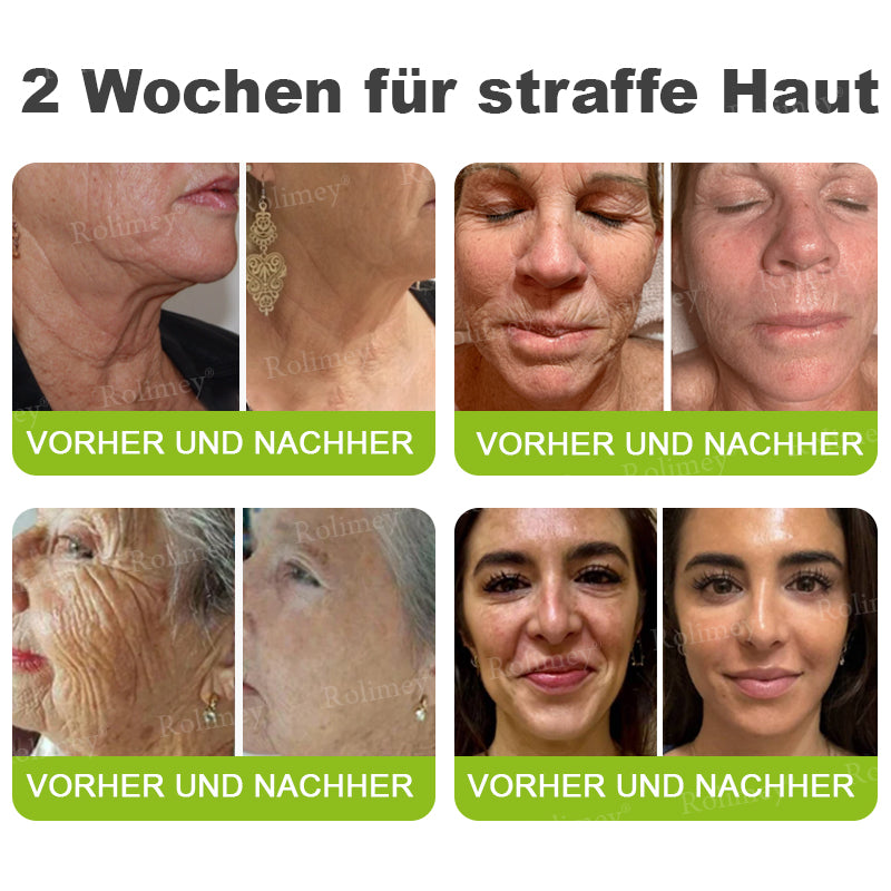 💫💫🍀Jetzt jugendliche Haut zurückgewinnen 💫Rolimey® Botox & Vita-A Retinol Shot Falten-Lift Straffungscreme👩‍🔬LETZTER TAG – 70 % RABATT