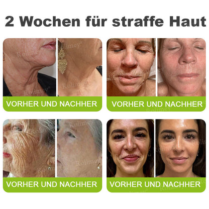 💫💫🍀Jetzt jugendliche Haut zurückgewinnen 💫Rolimey® Botox & Vita-A Retinol Shot Falten-Lift Straffungscreme👩‍🔬LETZTER TAG – 70 % RABATT